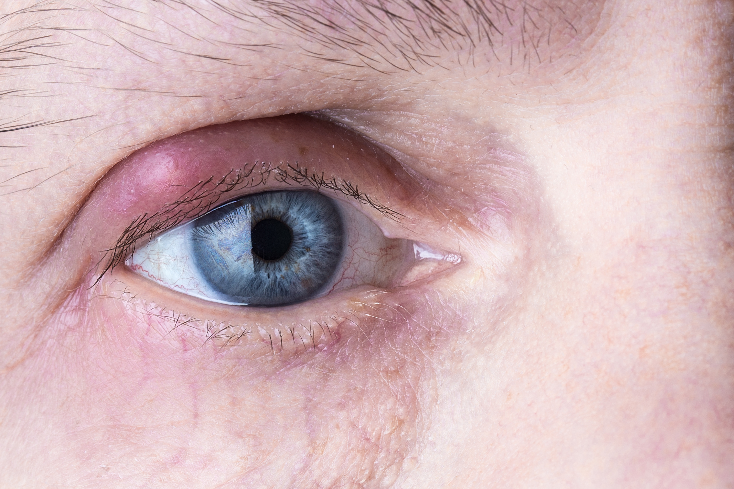 How To Get Rid of a Stye | Vision Direct AU